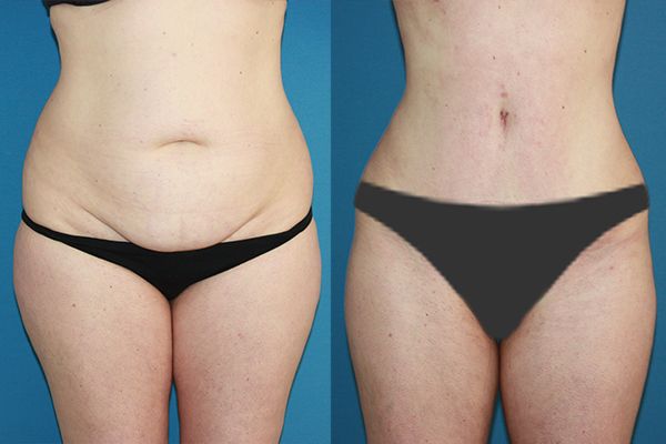 Abdominoplastia Tulua HD, lo último en cirugía estética para corregir el abdomen y crear un nuevo ombligo