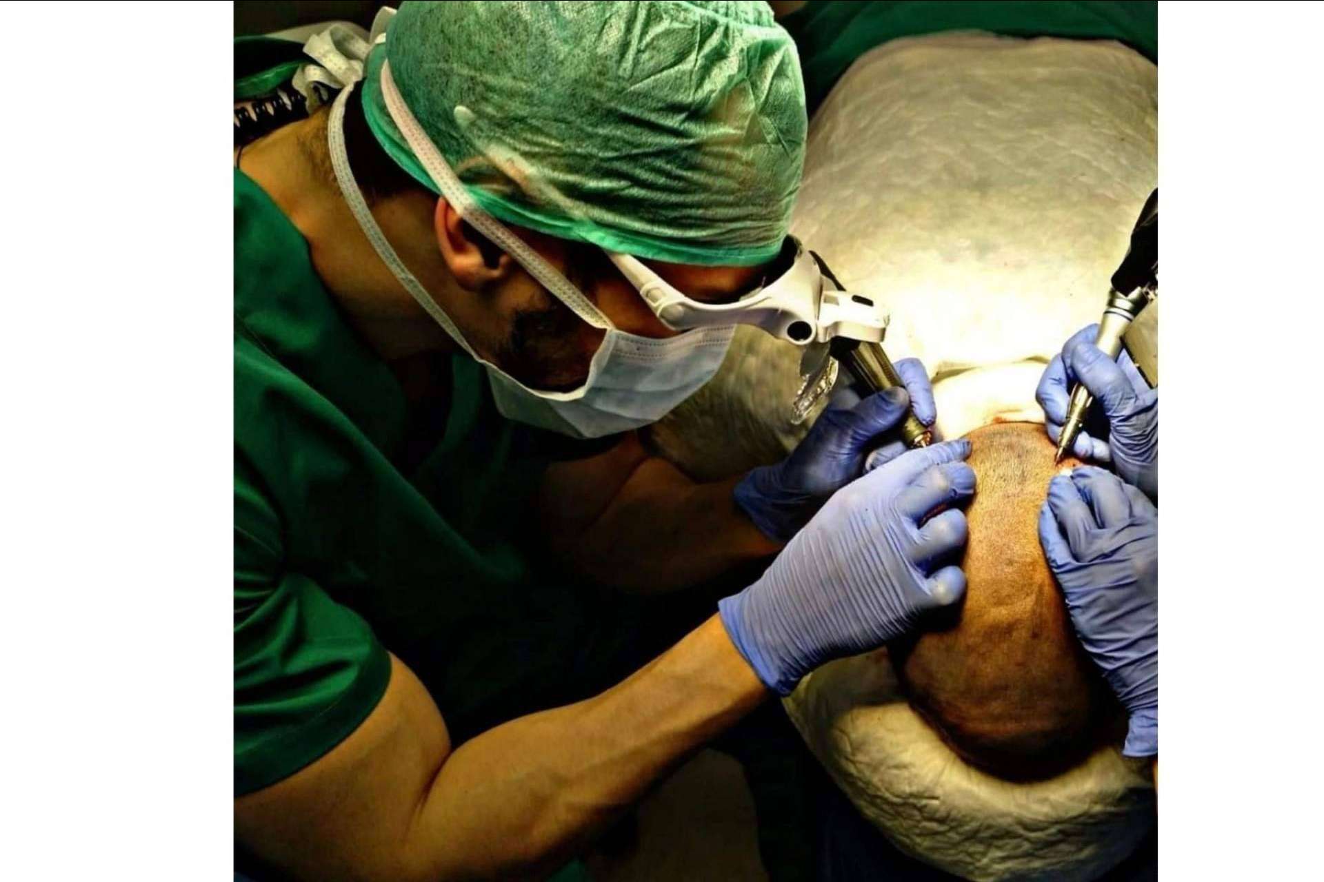 ¿A qué edad es más recomendado realizarse un injerto capilar?, por Doctor Bern
