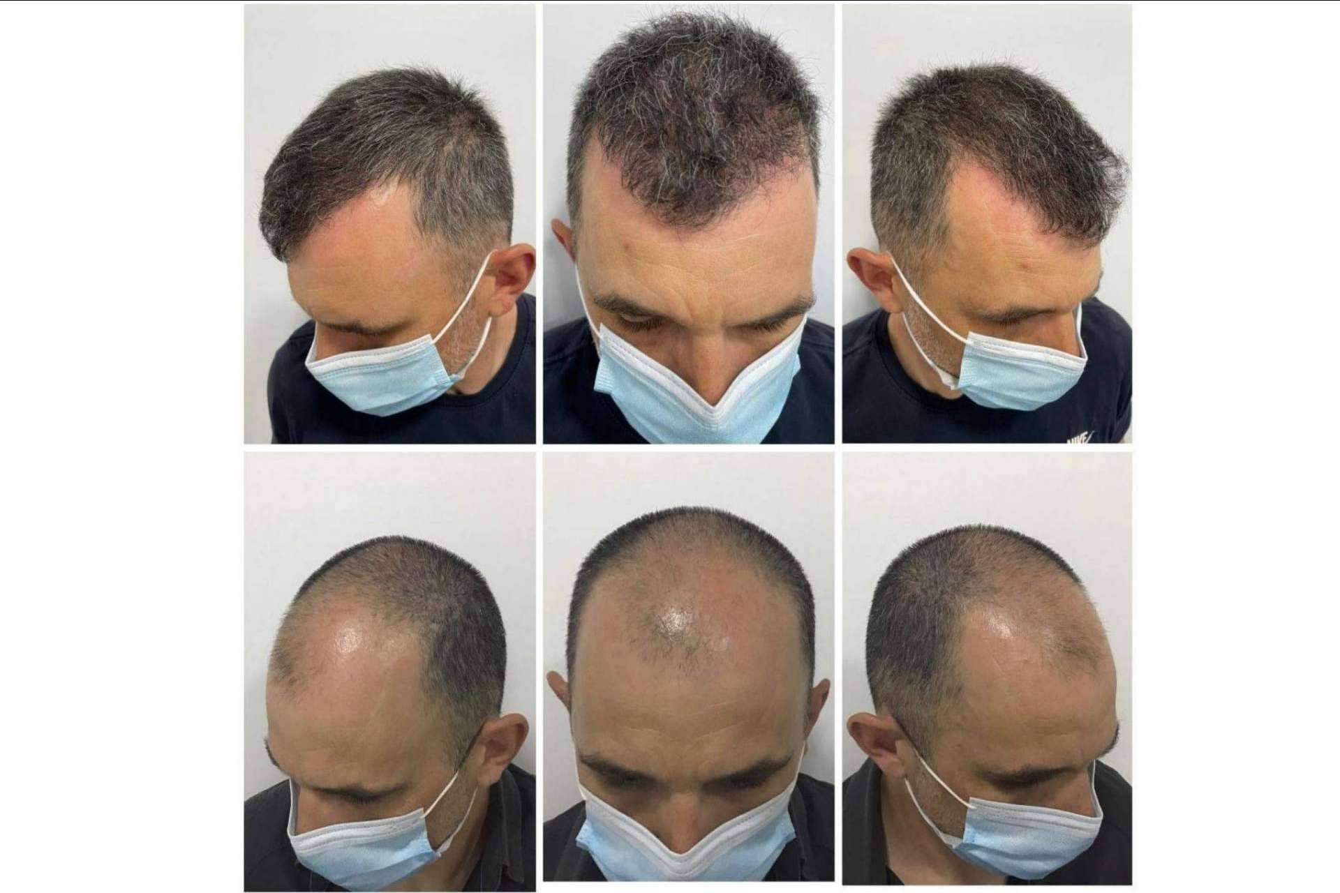 Los beneficios del tratamiento de mesoterapia capilar del Dr. Bruno Jacobovski