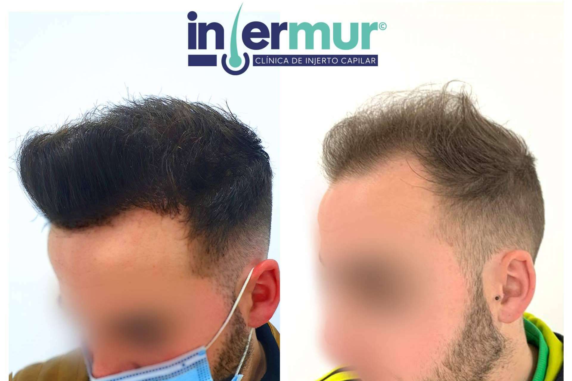 La técnica de injerto capilar de Injermur que permite operaciones sin cicatriz
