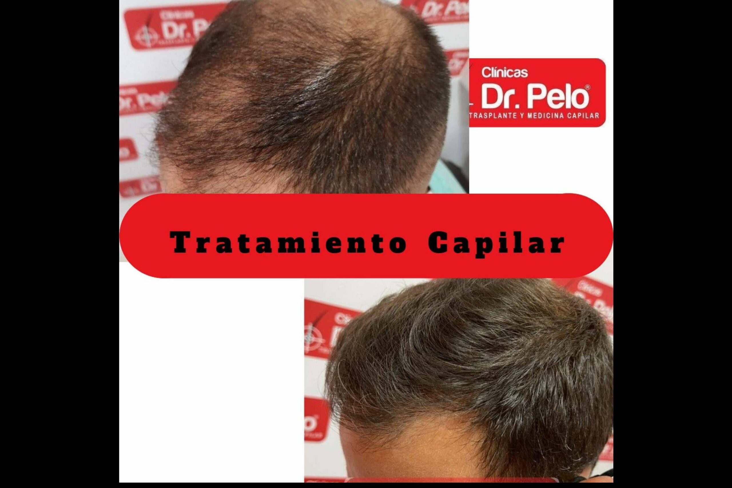 La red de Clínicas Dr. Pelo dispone de todo tipo de tratamientos capilares