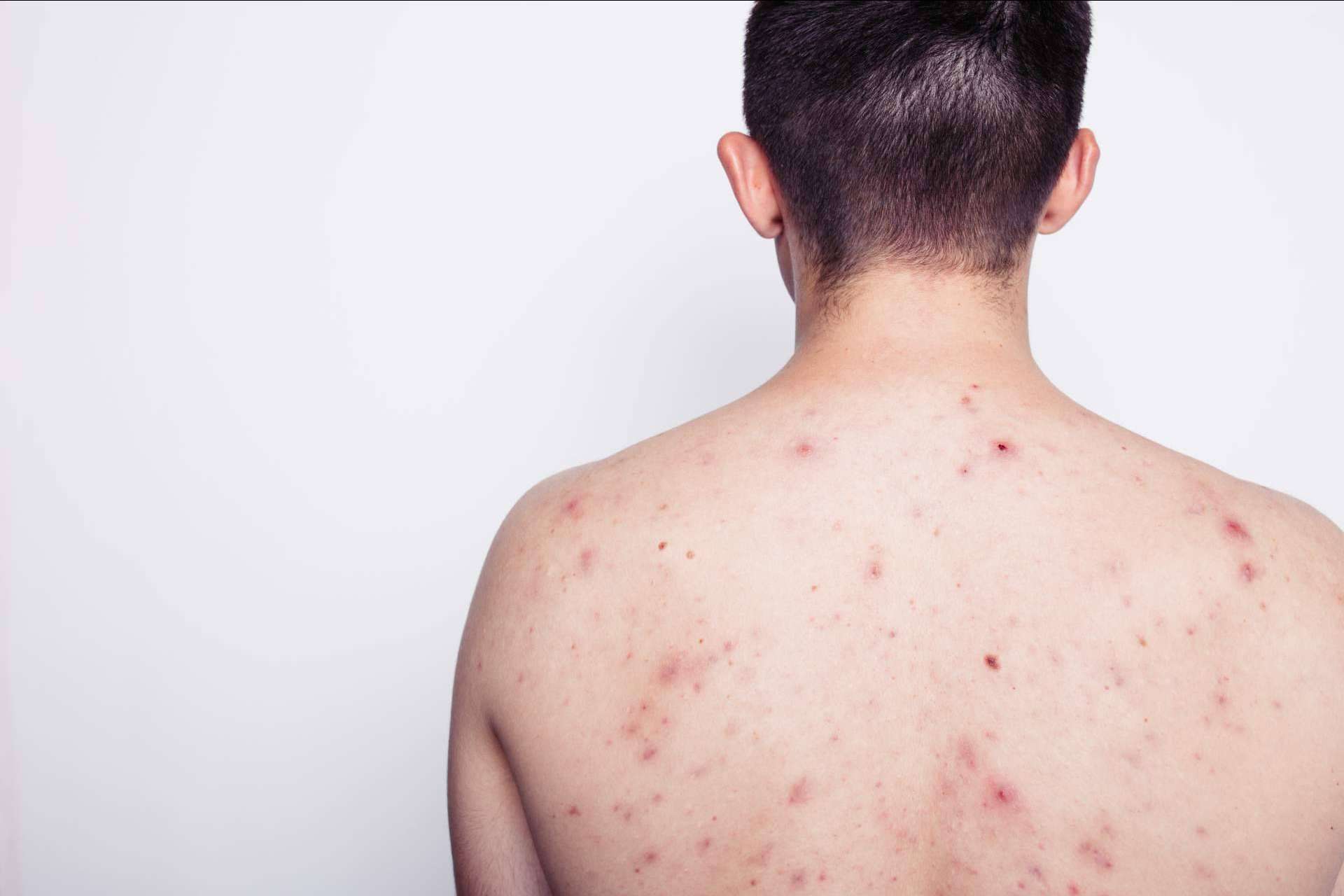AcnéXero, la aplicación ideada por dermatólogos que propone soluciones efectivas para eliminar el acné