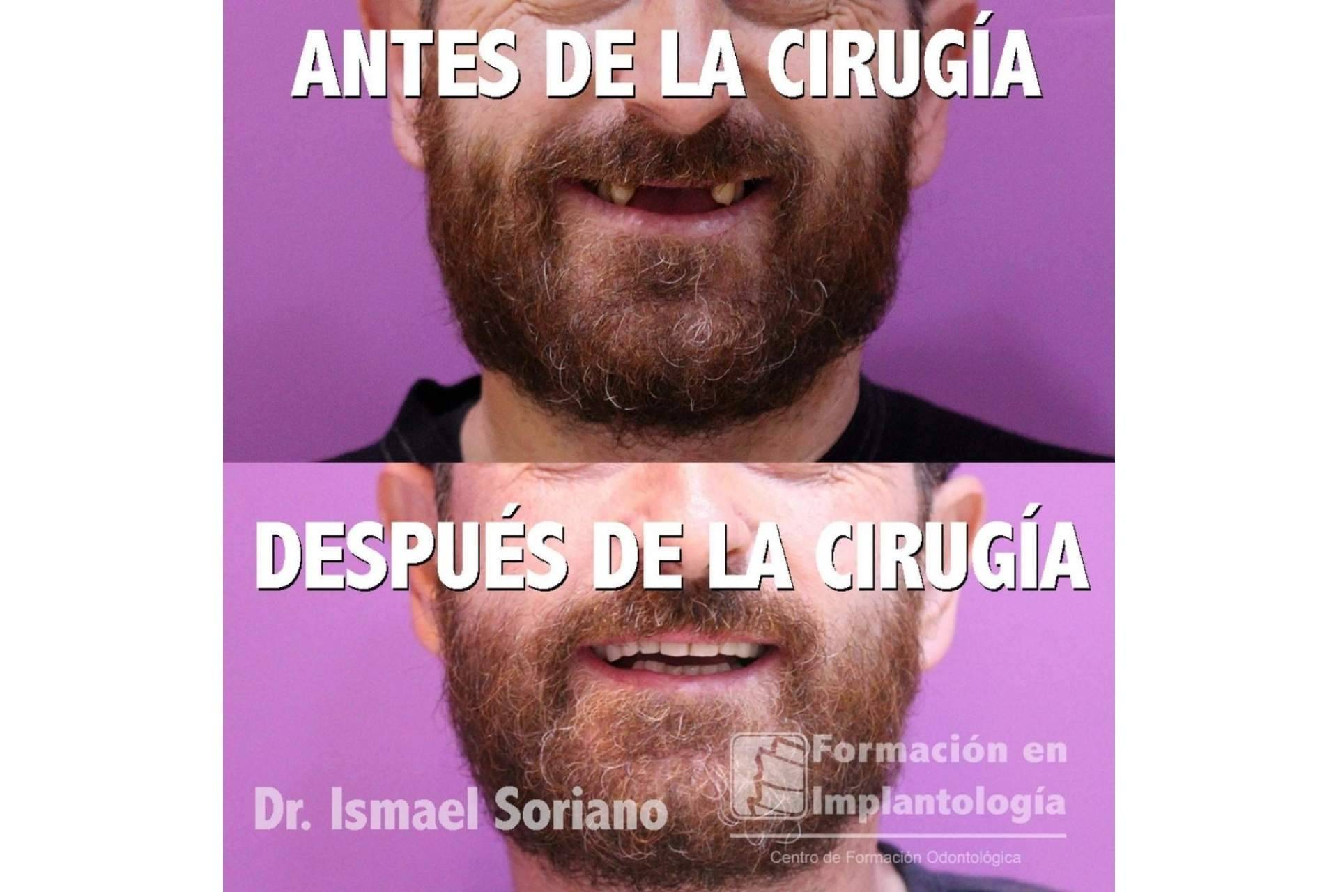 La técnica de implantes con dientes inmediatos del Dr. Ismael Soriano ofrece numerosas ventajas a los pacientes