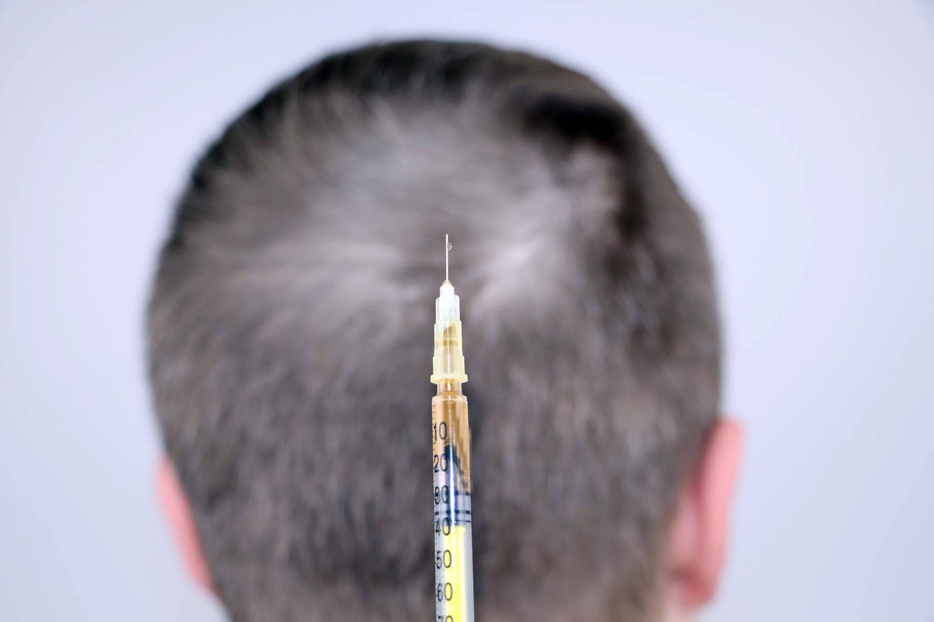 La mesoterapia capilar es un tratamiento que realiza el Dr. Bruno Jacobovski para el cuidado profundo del cuero cabelludo ante la caída del cabello