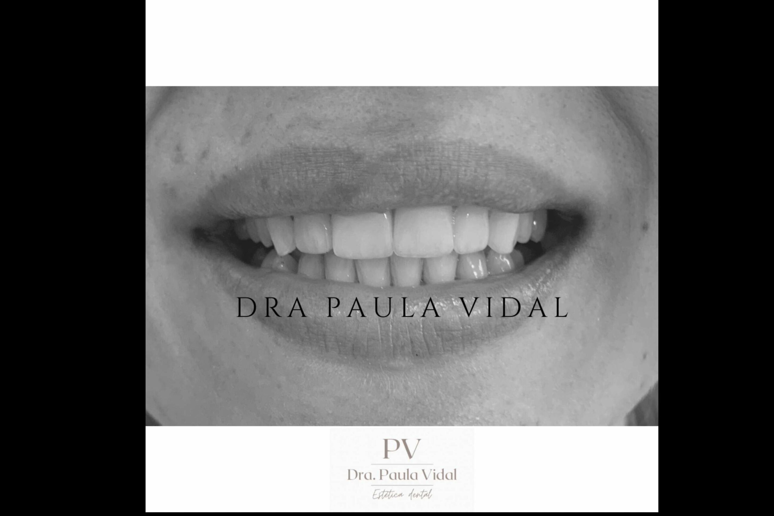 El servicio de carillas dentales en la Clínica Paula Vidal