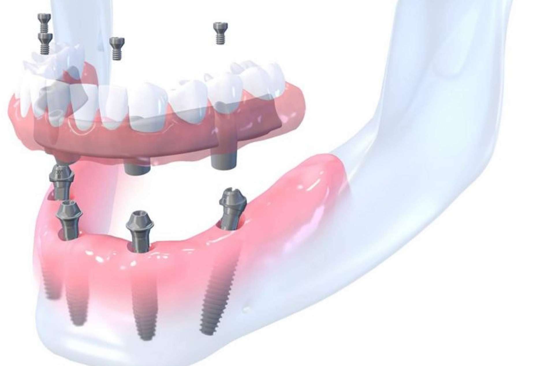 La clínica dental Bordonclinic lleva a cabo rehabilitaciones orales complejas en un día