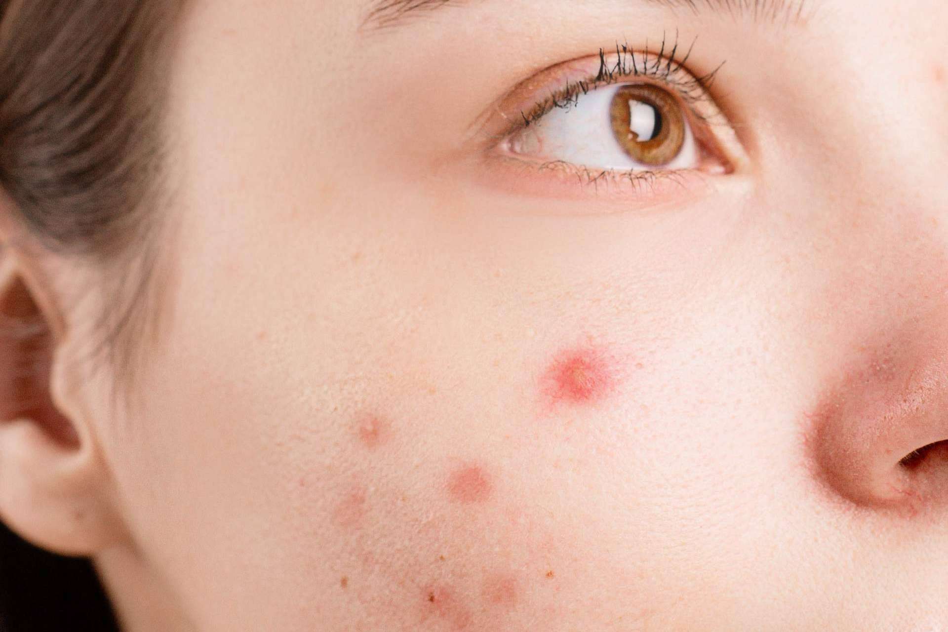 Los beneficios del tratamiento contra el acné de Bėyo Beauty