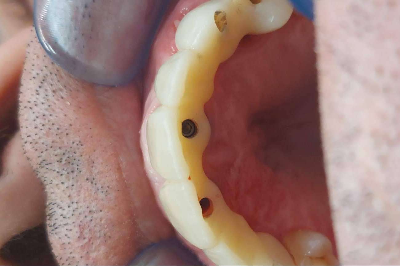 Dentinova realiza implantes dentales en un día con su tecnología digital