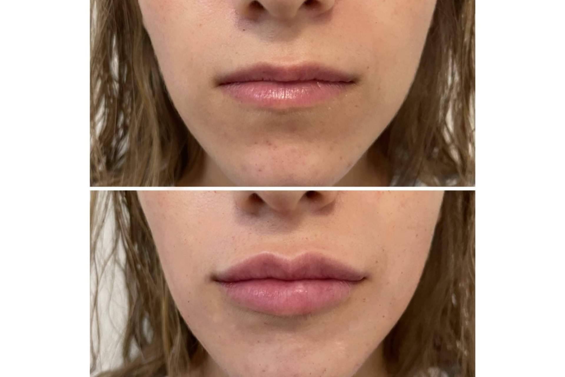 ¿Se puede conseguir un aumento de labios en Madrid con resultados naturales?, por la Dra. Cecilia Arthur
