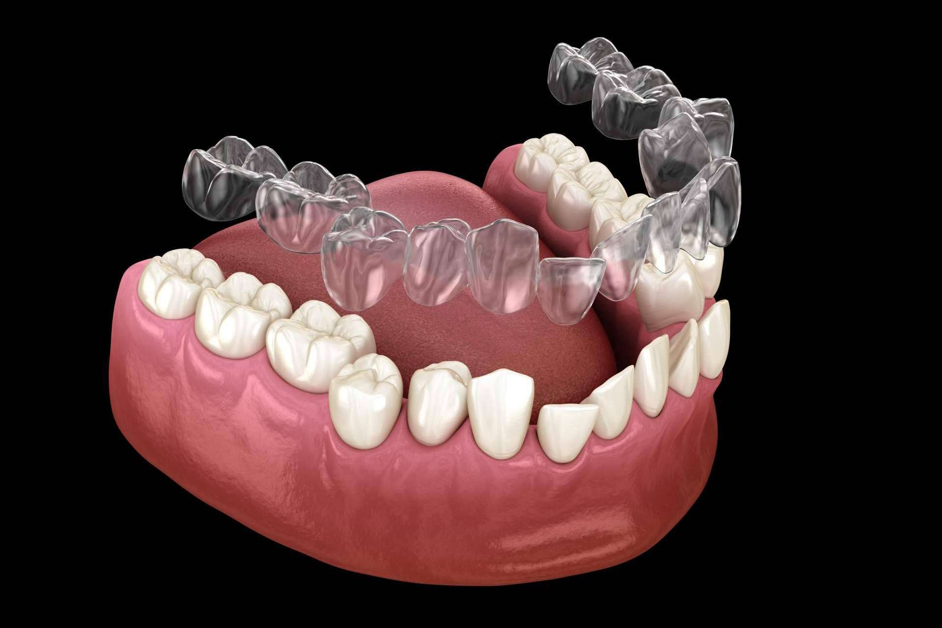 La Clínica Dental Bucalia ofrece tratamientos de ortodoncia invisible en Valencia