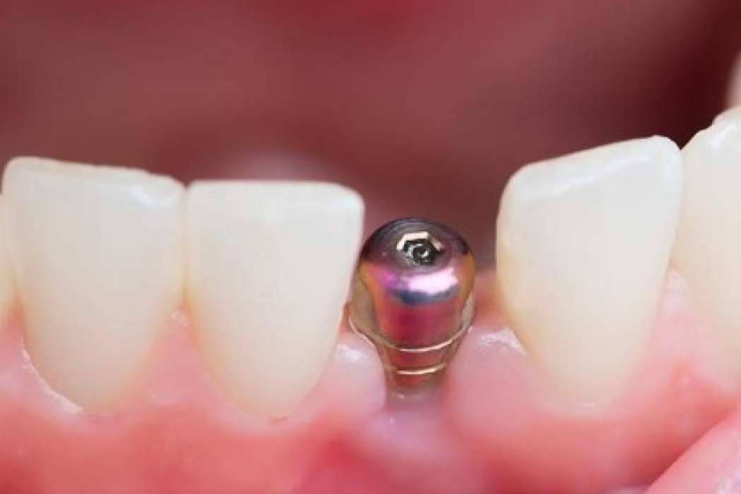 Clínica Calvo de Mora acerca de los implantes dentales que lleva a cabo