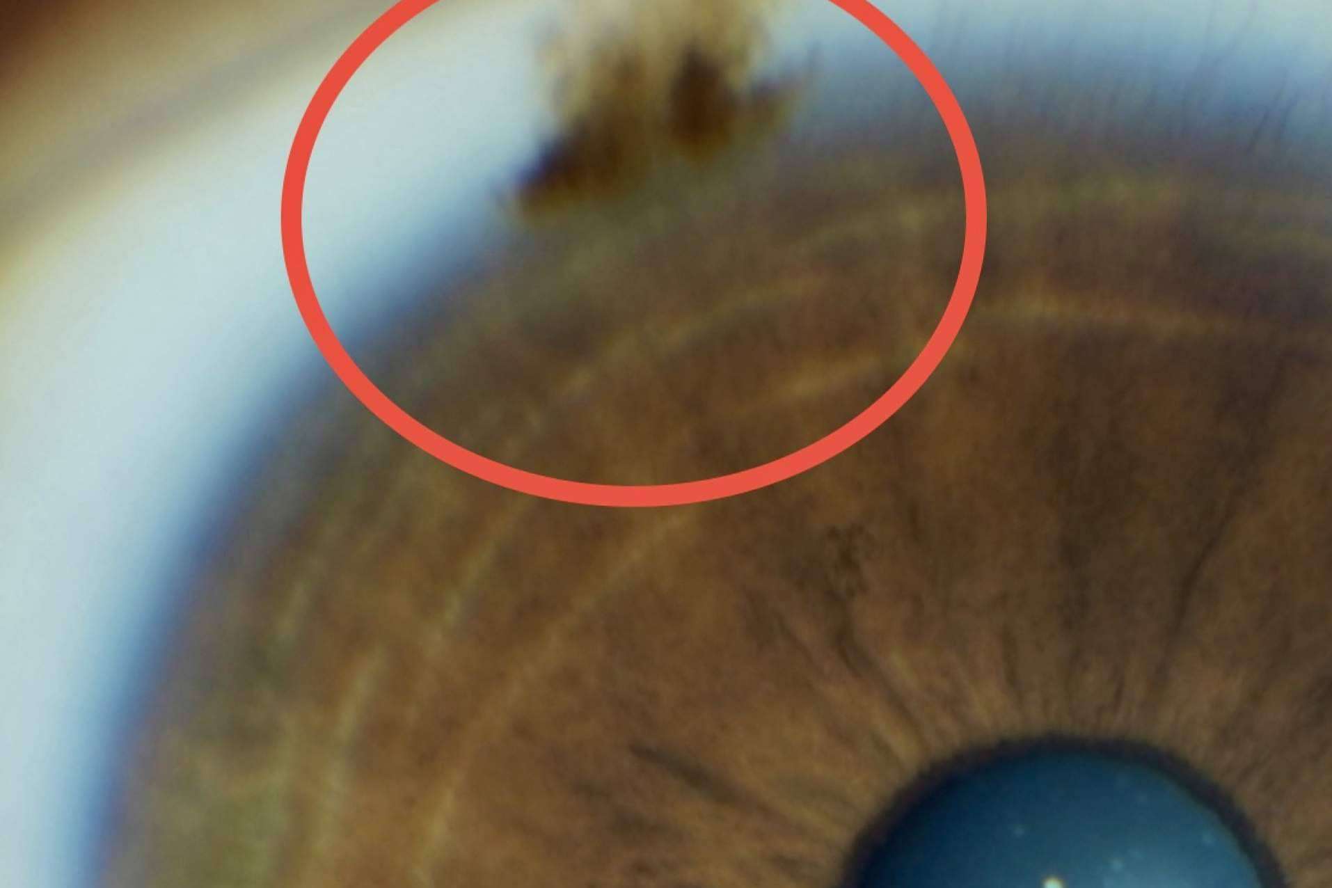 Tratamiento láser de las manchas pigmentarias de la conjuntiva